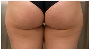 Thighs treatment area