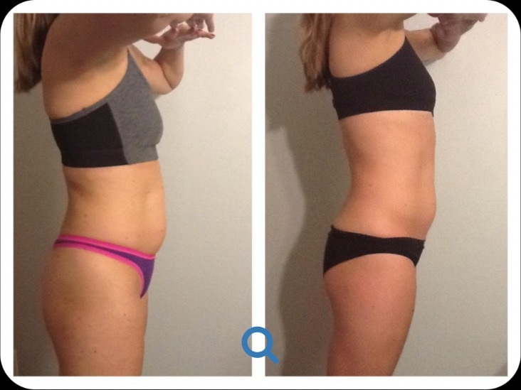 PV Laser Lipo client before and after result