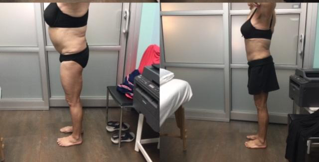 PV Laser Lipo before and after