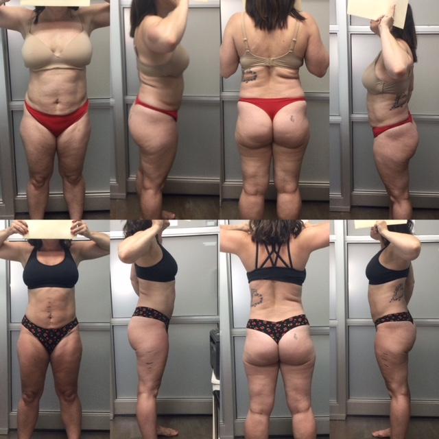 PV Laser Lipo client result