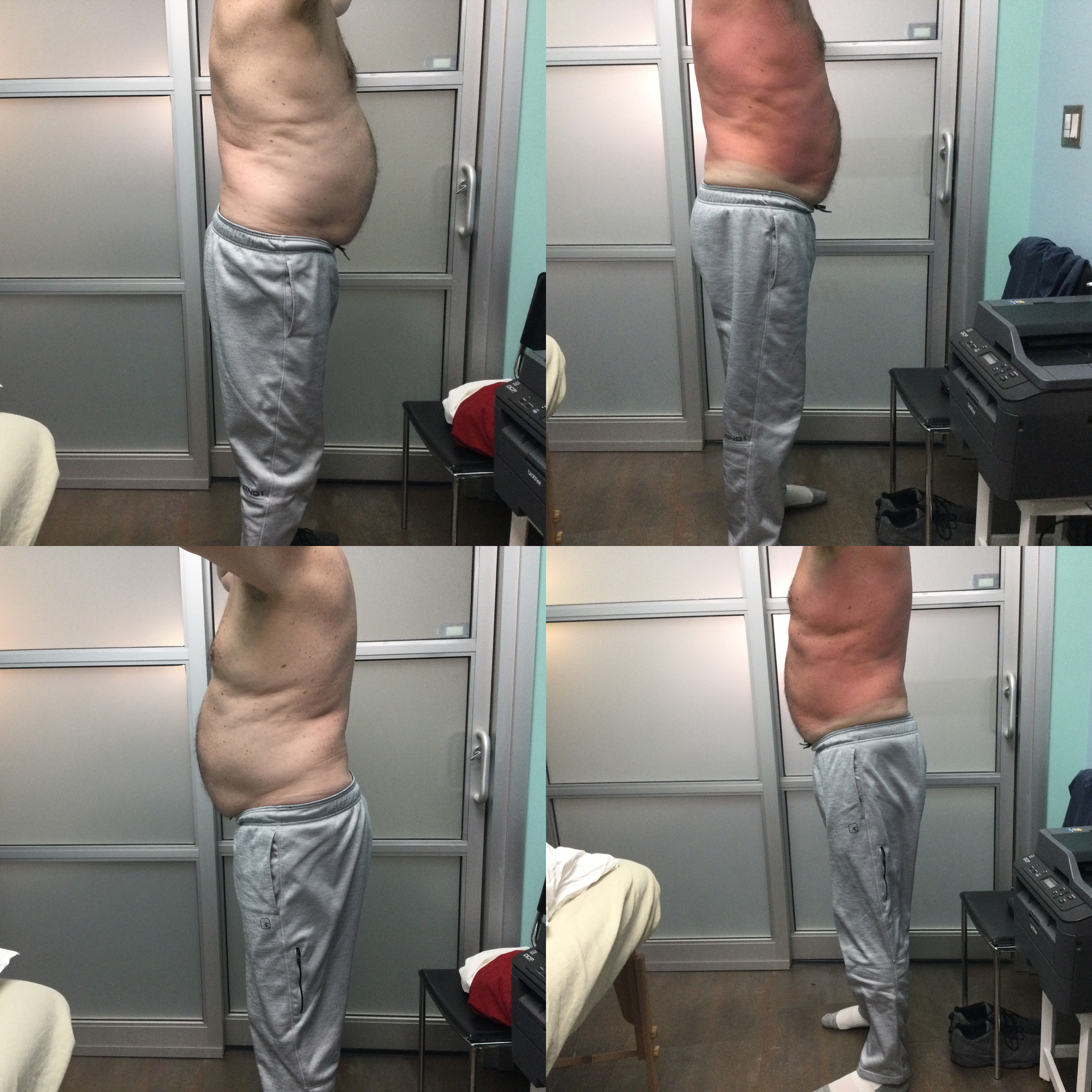 PV Laser Lipo client result
