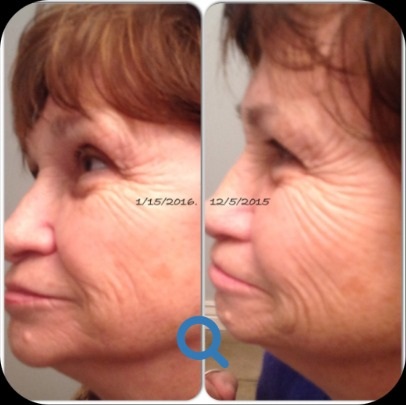 PV Laser Lipo before and after
